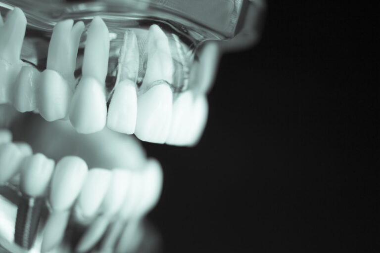 Implantologia dentale
