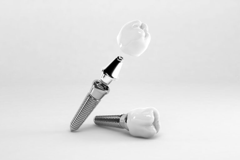 Cosa fare dopo un impianto dentale