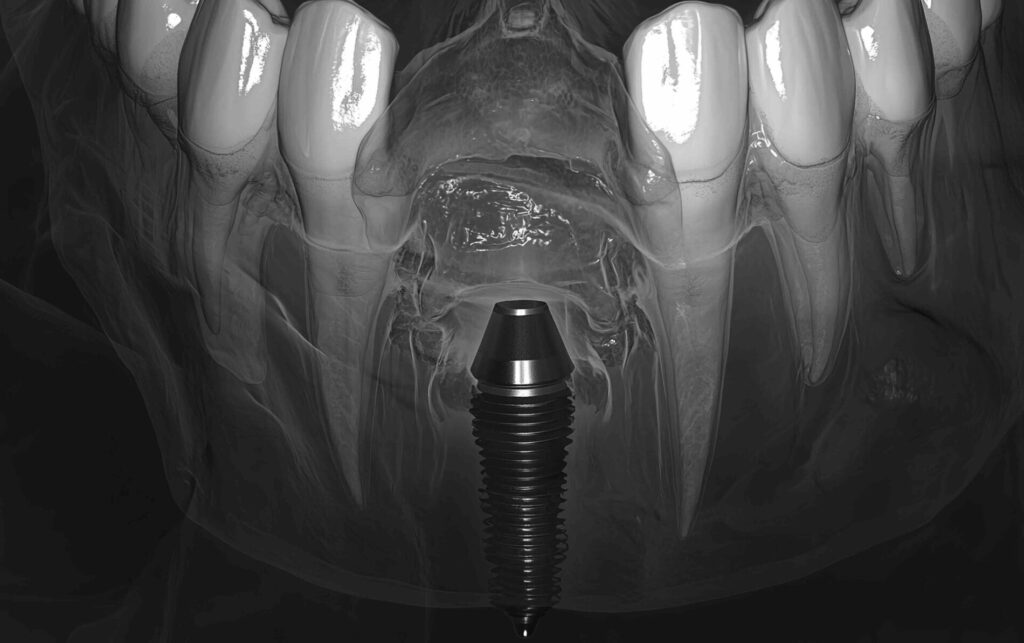 Implantologia dentale a Torino